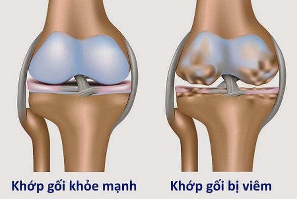 Triệu chứng bệnh viêm khớp gối